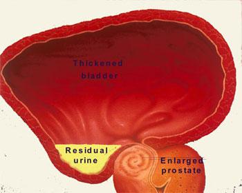 Fig 3. BPH causes bladder blockage leading to residual urine Fig 3. BPH causes bladder blockage leading to residual urine