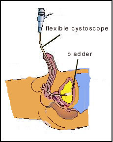 Fig 2. Flexible cystoscopy can easily be done in the clinic under local anaesthesia Fig 2. Flexible cystoscopy can easily be done in the clinic under local anaesthesia