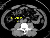 CT Scan Picture of CT Scan