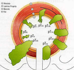 Bladder Cancer