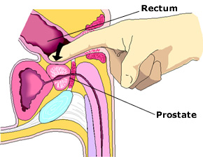 Picture of Digital rectal exam