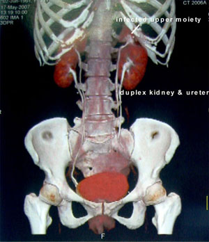 Duplex Kidney System