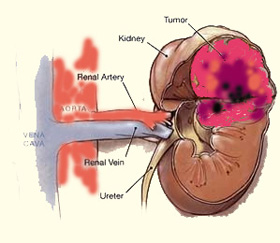 renal cancer