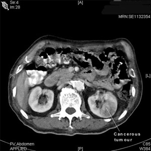 Renal Ct Scan