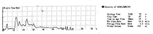 obstructed uroflow pattern