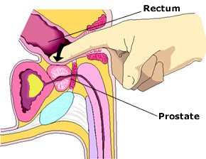 Digital rectal exam (DRE)