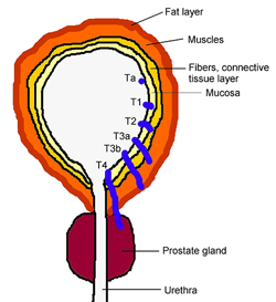 Kidney cancer