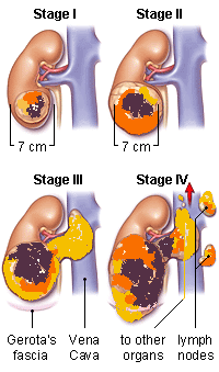 Kidney cancer