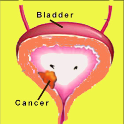Radical cystectomy Radical cystectomy