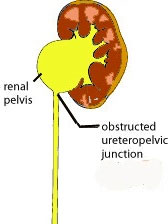 Pyeloplasty Pyeloplasty