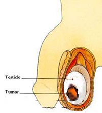 Testicular cancer