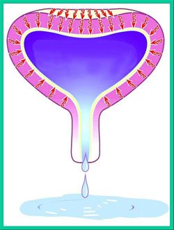 Urge incontinence Urge incontinence
