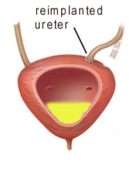 ureter reimplantation surgery ureter reimplantation surgery