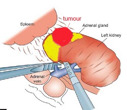 Robotic Laparoscopic Adrenalectomy Robotic Laparoscopic Adrenalectomy