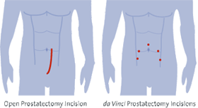 Radical Prostatectomy Radical Prostatectomy