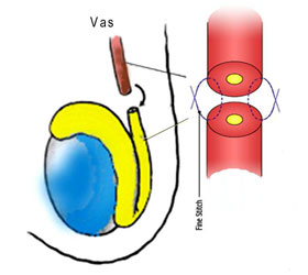 Reversal of Vasectomy Reversal of Vasectomy