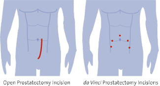 Prostatectomy Incision