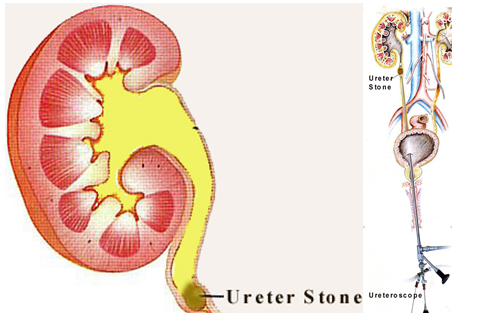 urs kidney lithotripsy stone surgery ureteroscopic urology treatment stones transurethral done india pain complications eswl case remove renal turp prostate