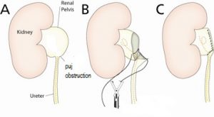 Kidney-Pyeloplasty