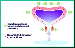 Urinary Incontinence - Chin Chong Min Urology & Robotic Surgery Centre