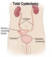 Total Cystectomy