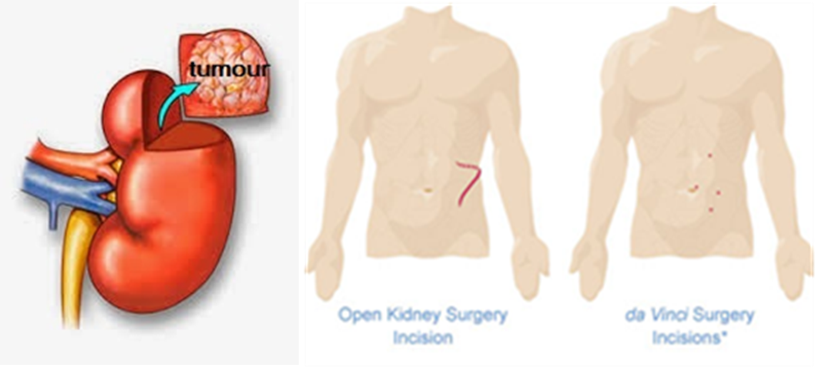 robotic-partial-nephrectomy-chin-chong-min-urology-robotic-surgery