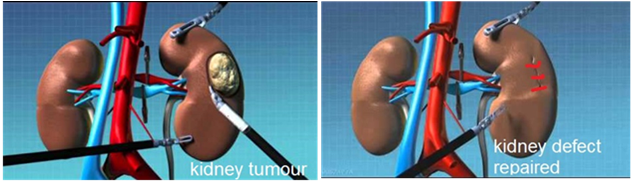 Robotic Partial Nephrectomy Recovery Time