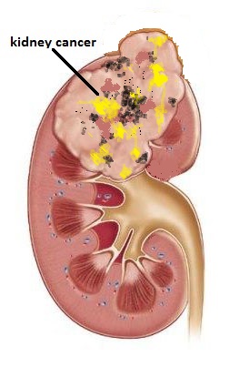 A Study On Renal Cancer