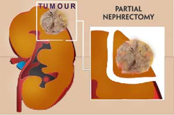 Nephrectomy