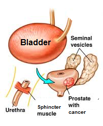 prostate prostatectomy radical removal gland cancer surgery entire fig treatment robotic