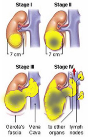 kidney cancer stages stage surgery symptoms fig