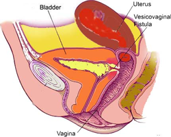 Gynae-urology