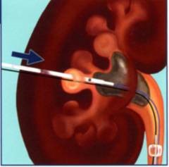 pcnl percutaneous nephrolithotomy urology