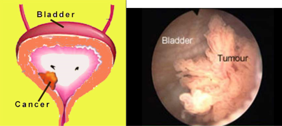 What Are The Symptoms Of Bladder Cancer In A Woman Causes And Symptoms Of Bladder Cancer