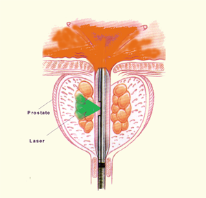 green light laser surgery prostate