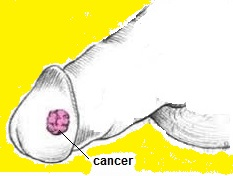 penile cancer early signs