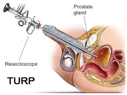 Transurethral Resection of Prostate TURP Chin Chong Min