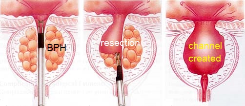 Transurethral Resection Of Prostate Turp Chin Chong Min Urology Robotic Surgery Centre