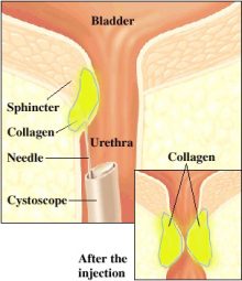 Collagen injection to close the bladder neck