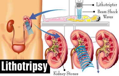 lithotripsy machine diagram