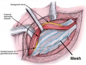 Hernia Repair  Chin Chong Min Urology & Robotic Surgery Centre