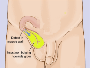 Hernia Repair Chin Chong Min Urology Robotic Surgery Centre