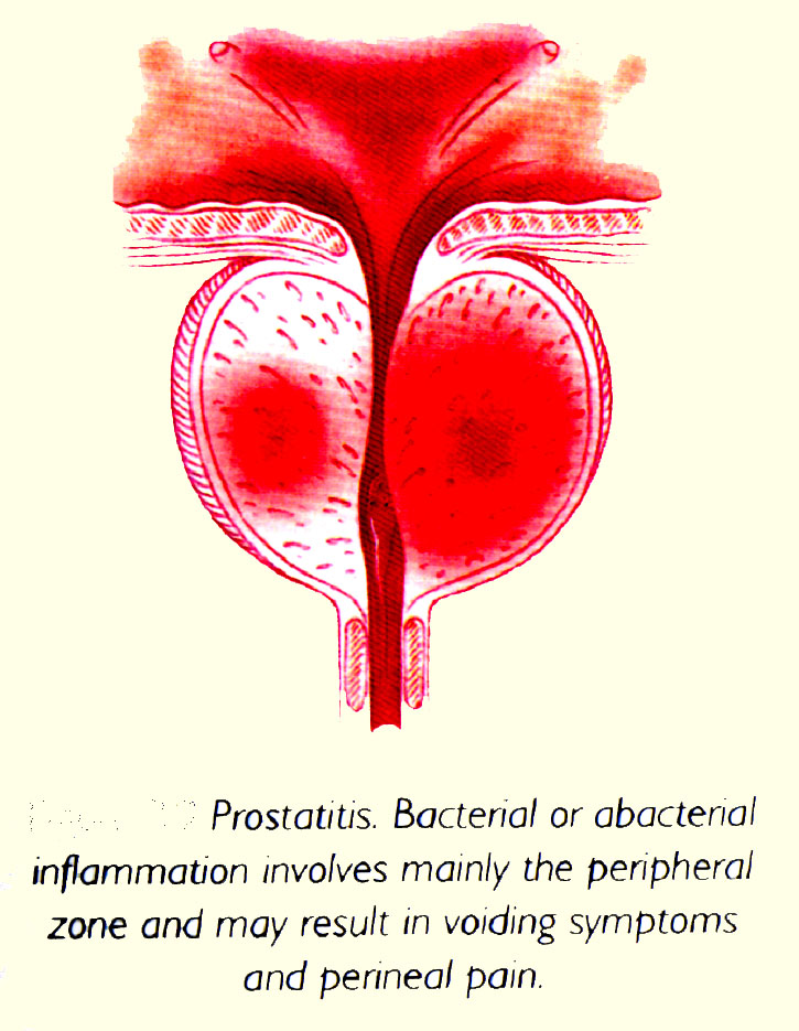 Простата острое. Простатит рисунок. Хронический застойный простатит.