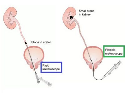 Rigid vs flexible ureteroscope