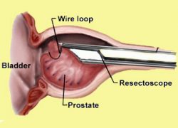 (a) Standard TURP