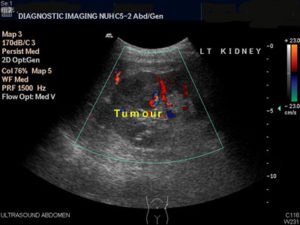 kidney ultrasound tumor