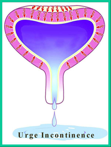 Bladder Injections  Chin Chong Min Urology & Robotic Surgery Centre