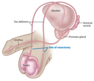 Vasectomy