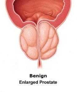 hogyan ellenőrizze a prosztata ujját 21 év prostatitis