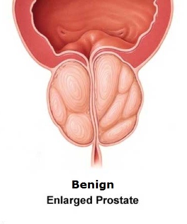 Persistent Prostatitis Chin Chong Min Urology Robotic Surgery Centre